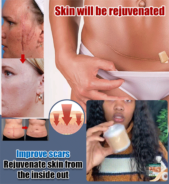 Silicone scar stickers