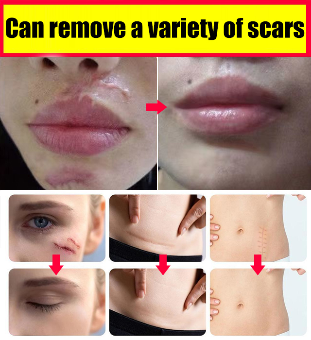 Silicone scar stickers
