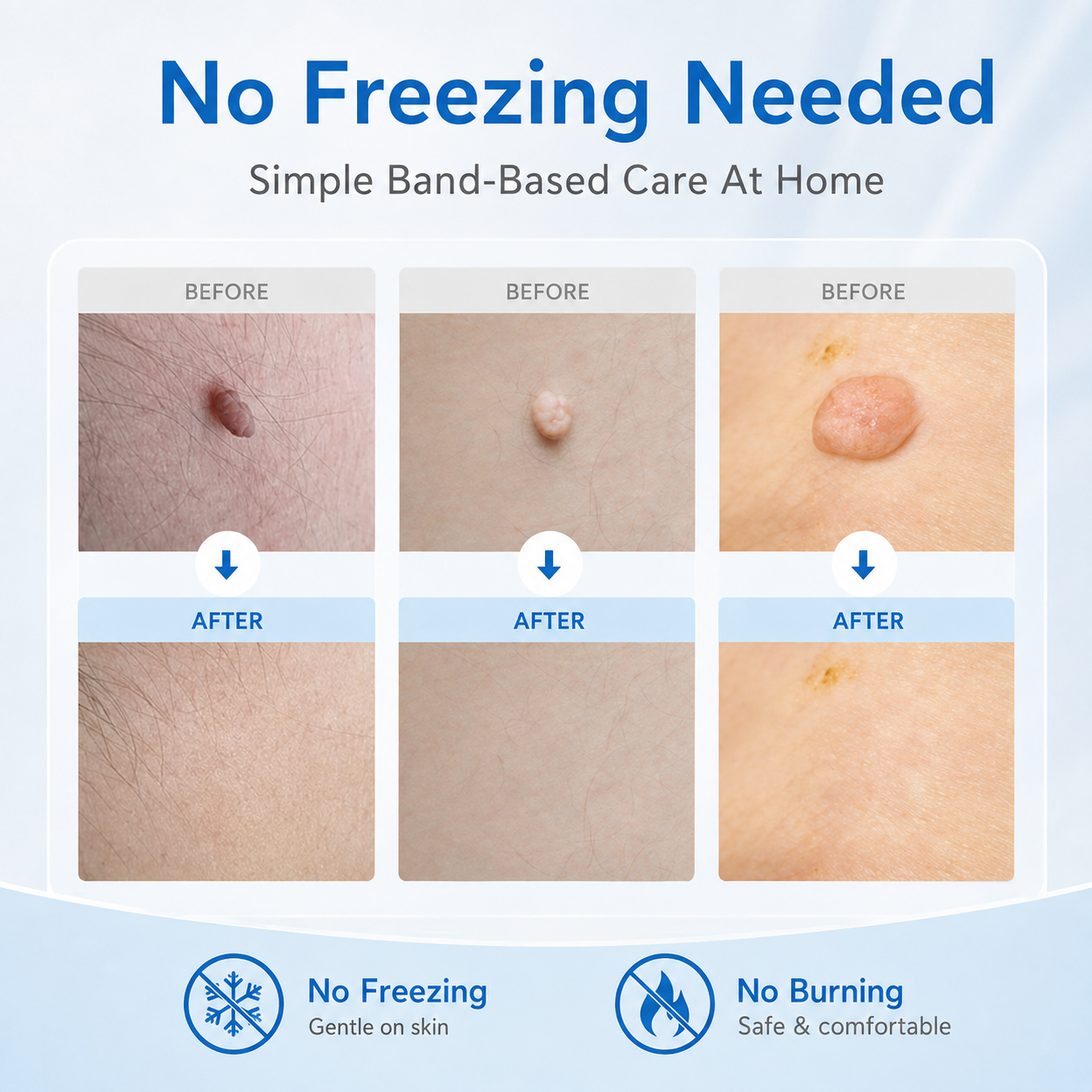 Step by step loading and applying skin tag removal band