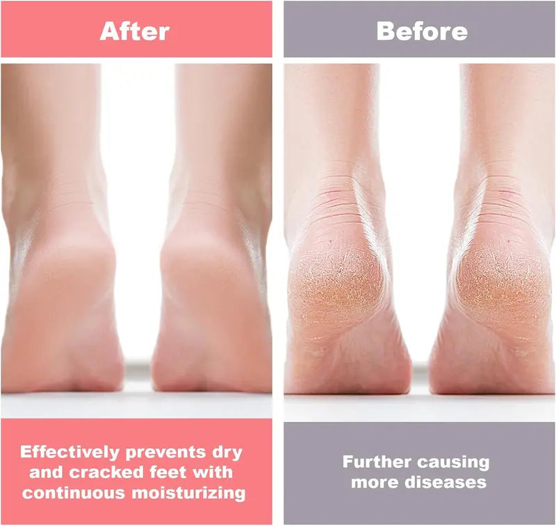 Silicone moisturizing foot socks before and after style foot care routine example