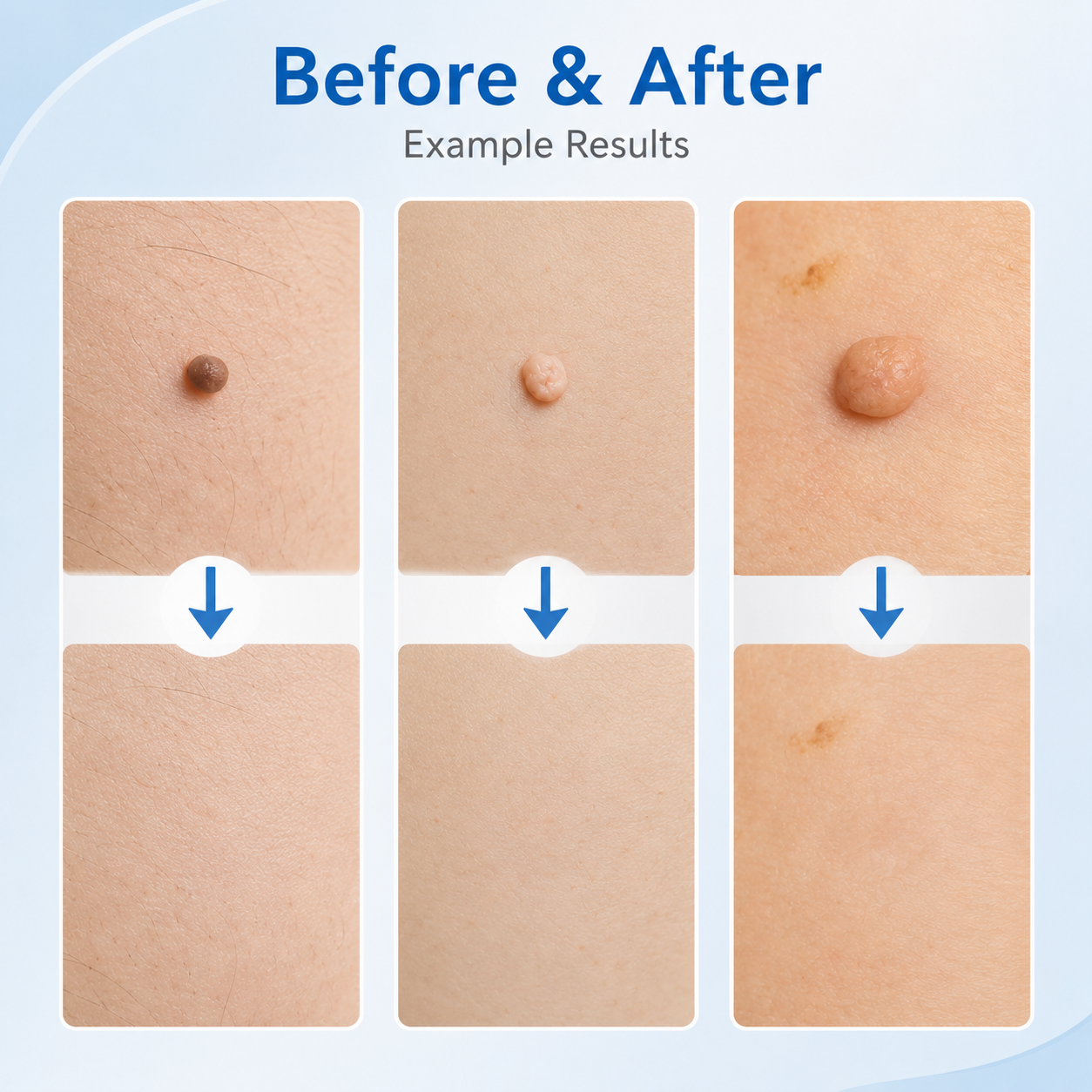 Skin tag blood restriction and natural falling off timeline