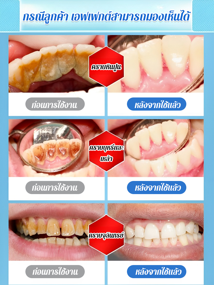  เครื่องทำความสะอาดฟันแบบอัลตราโซนิกที่แท้จริง