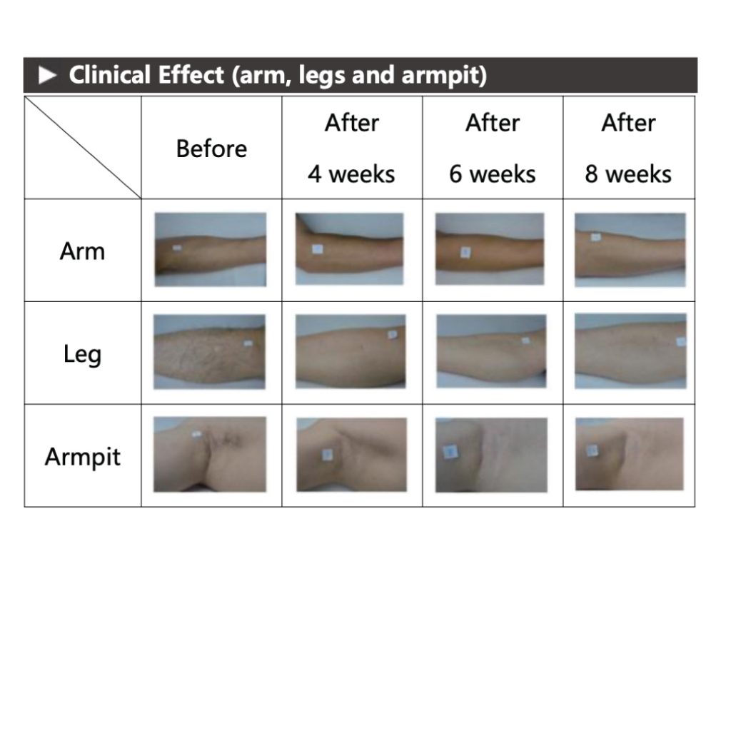 Remove IPL Hair Removal