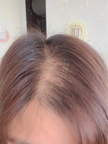 การเจริญเติบโตของเส้นผมอย่างรวดเร็วและหนาขึ้น