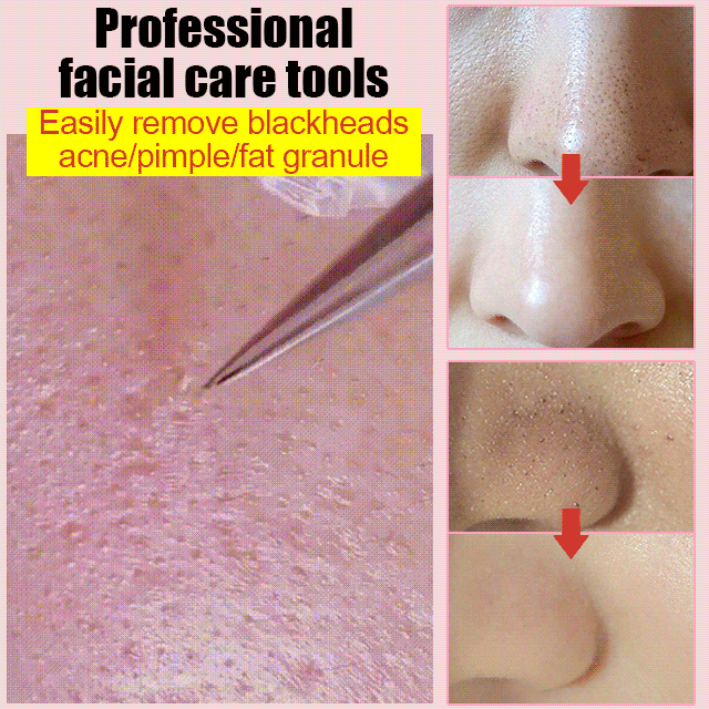 🪡Stainless Steel Acne and Blackhead Tweezers🧰Straight tip, 145° angled tip, 128° hook, covering all facial cleansing needs.