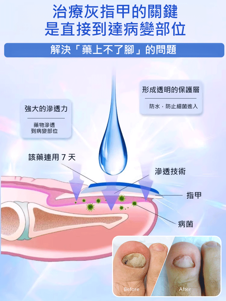 【0元購】真菌王灰指甲腳氣護理膏