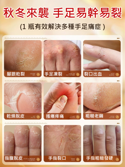手足皸裂膏