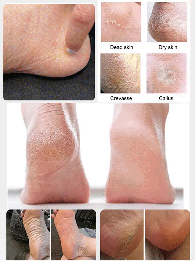 【Baby-Soft Feet】FootRevive™ - Gentle on Skin, Tough on Cracks! - Salon-Quality Results at Home!