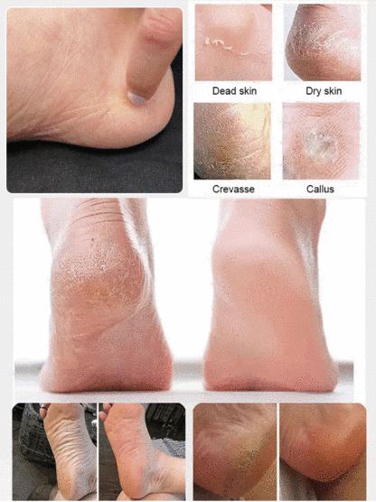 【Baby-Soft Feet】FootRevive™ - Gentle on Skin, Tough on Cracks! - Salon-Quality Results at Home!