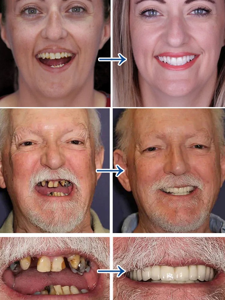 🦷Perfect dentures, Just like your real teeth, you can eat it anytime, hot, cold, sour or sweet.