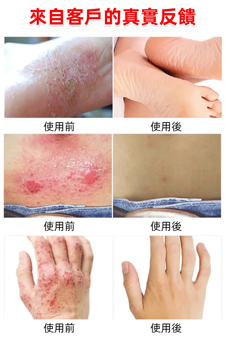 苗家祖大夫抑菌乳膏 苗家祖大夫抑菌乳膏