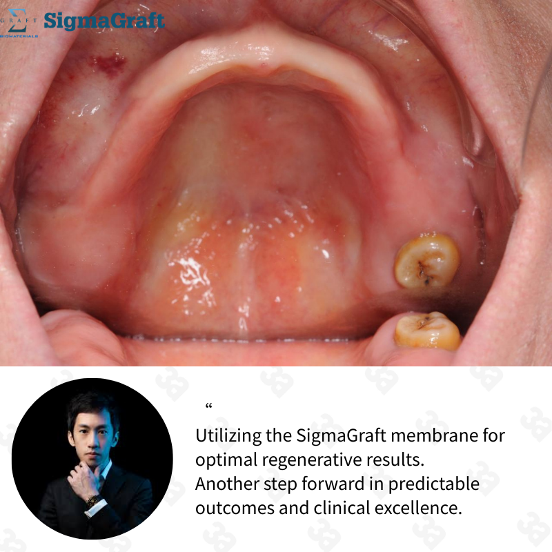InterCollagen Guide Resorbable Collagen Membrane