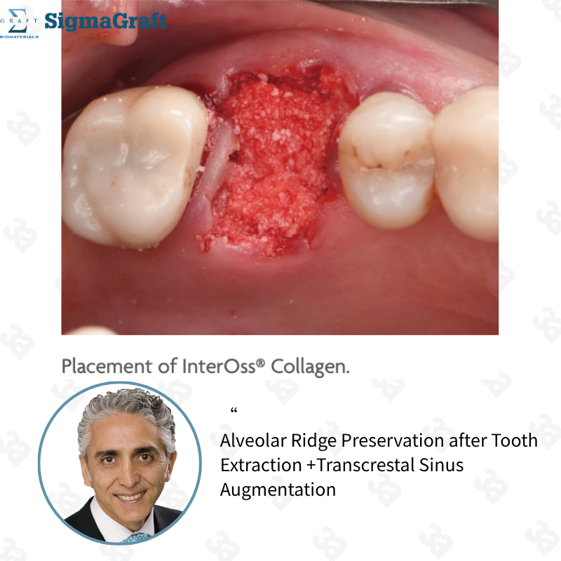InterOss Collagen Plug Anorganic Bone-collagen Composite