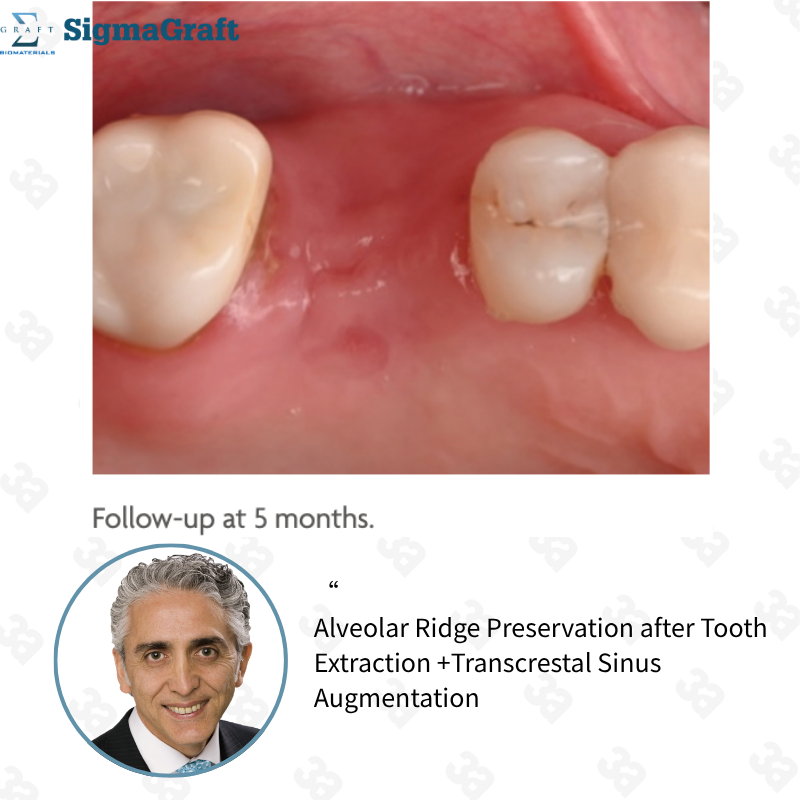 InterOss Collagen Plug Anorganic Bone-collagen Composite