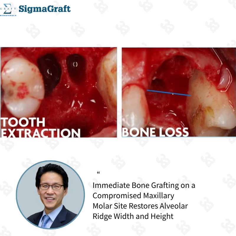 InterOss Anorganic Cancellous Bone Graft Granules