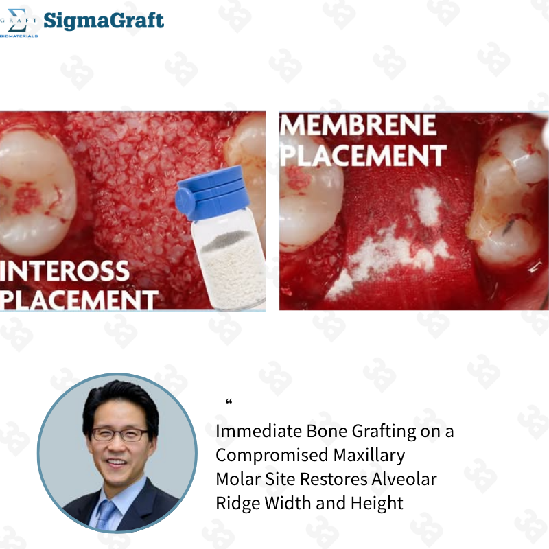 InterOss Anorganic Cancellous Bone Graft Granules
