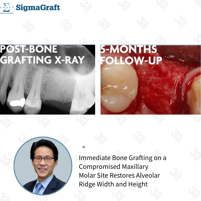 InterOss Anorganic Cancellous Bone Graft Granules