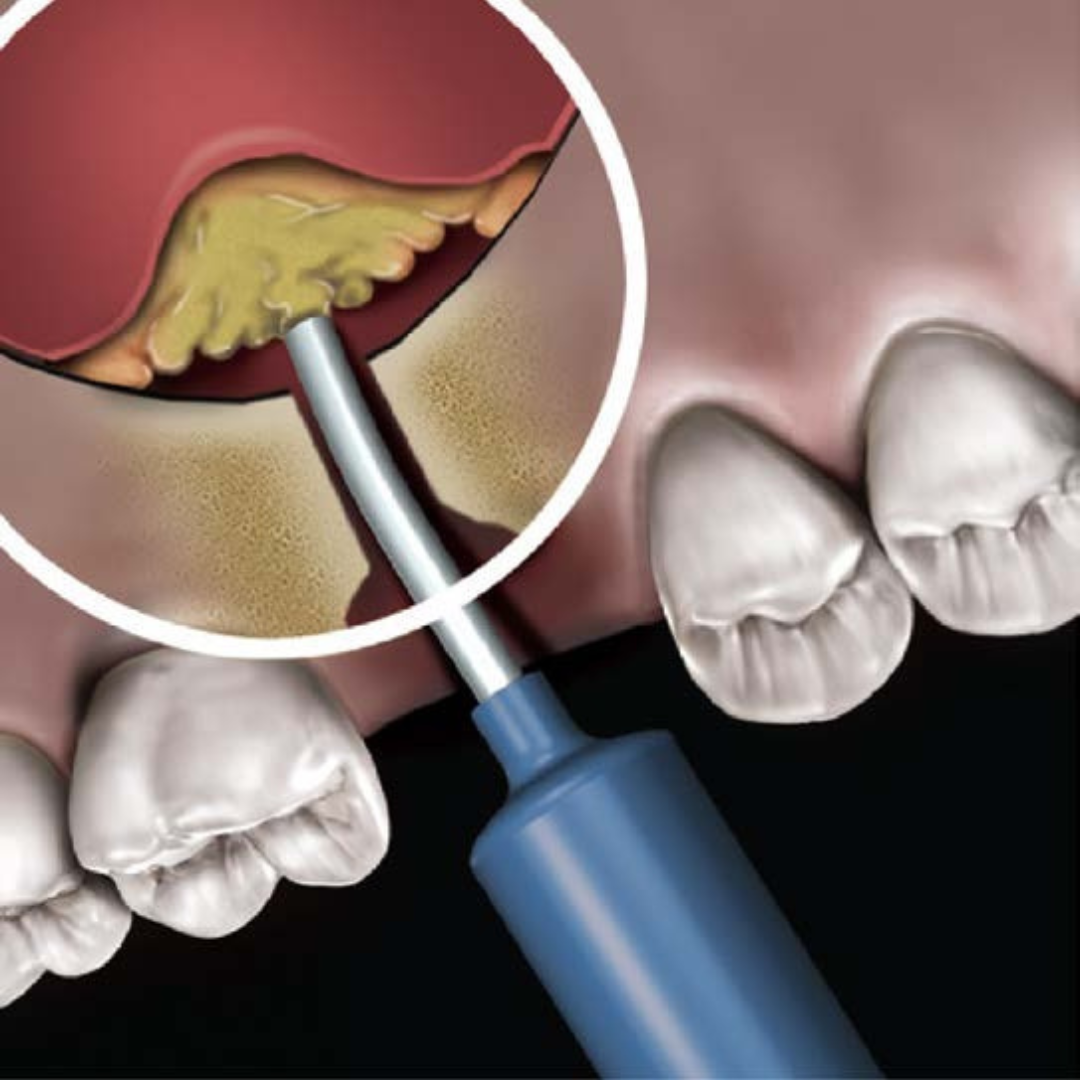NovaBone used in sinus augmentation procedure