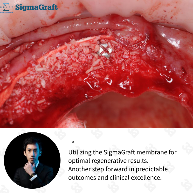 InterCollagen Guide Resorbable Collagen Membrane