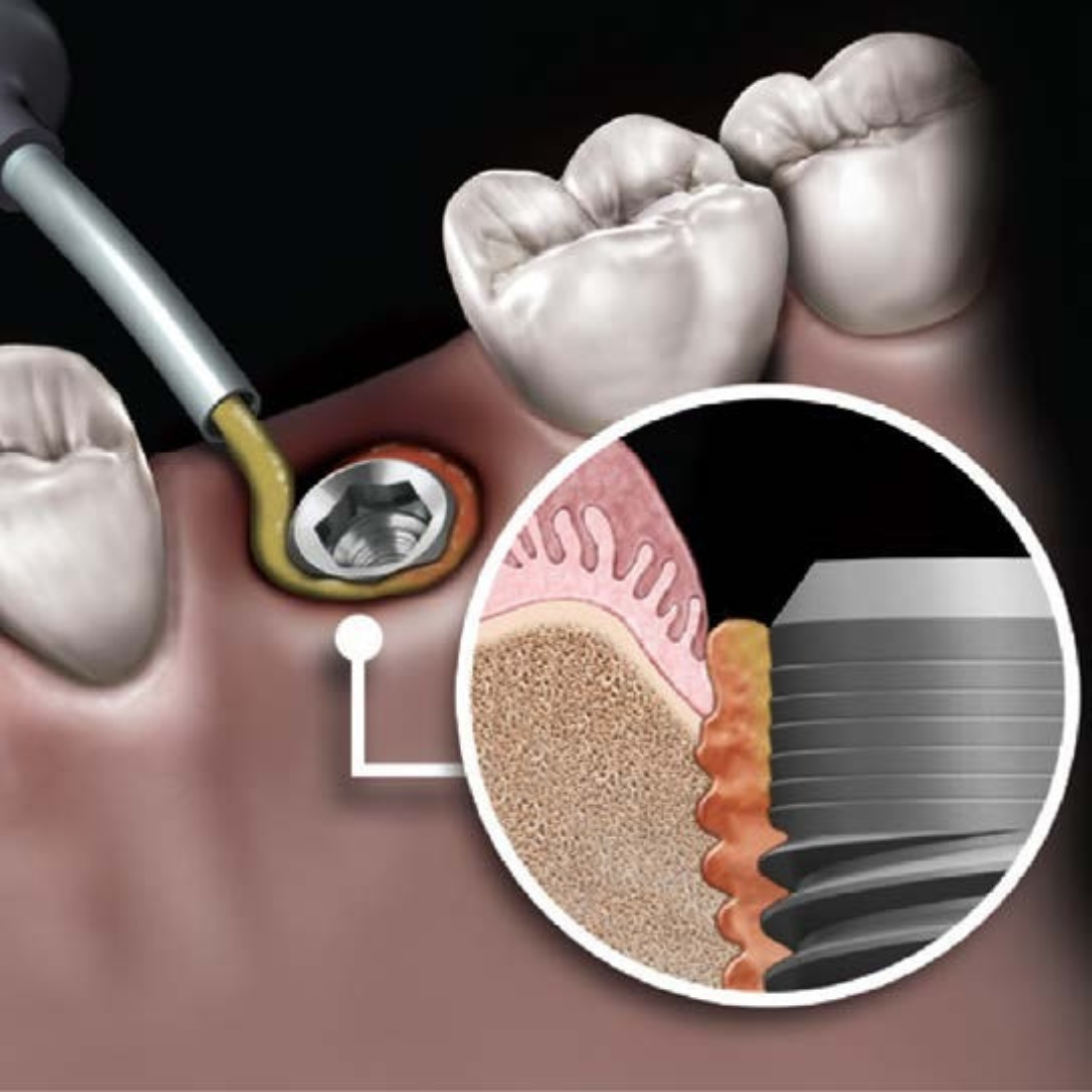 NovaBone application in peri-implant defect