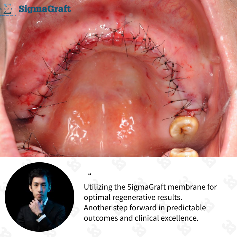 InterCollagen Guide Resorbable Collagen Membrane