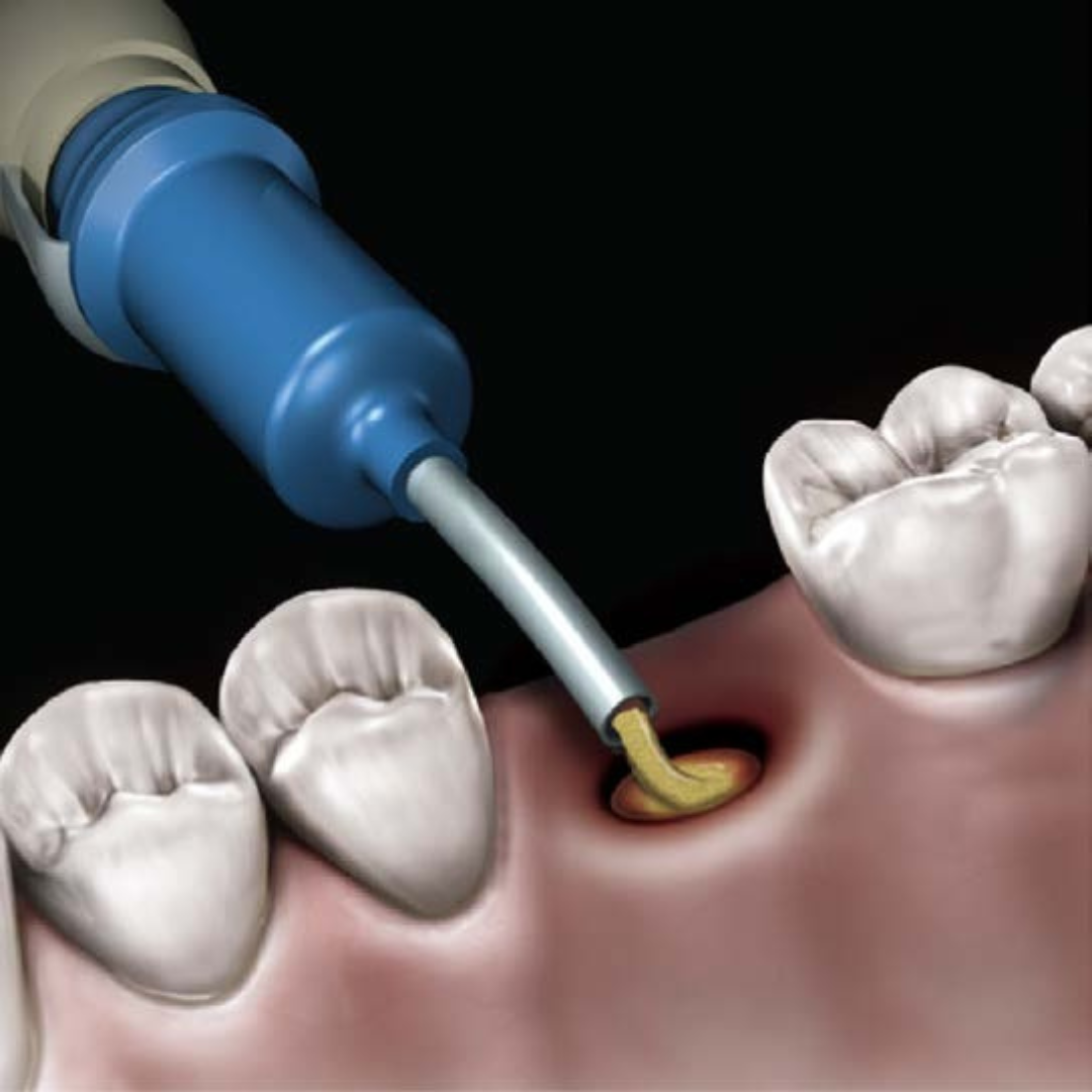 NovaBone graft used in full or partial extraction site