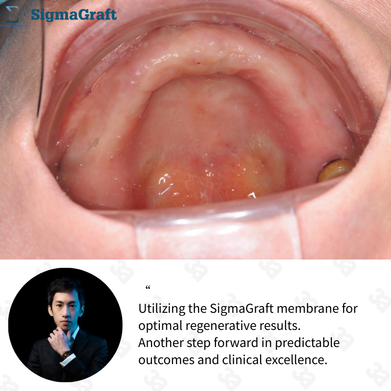 InterCollagen Guide Resorbable Collagen Membrane