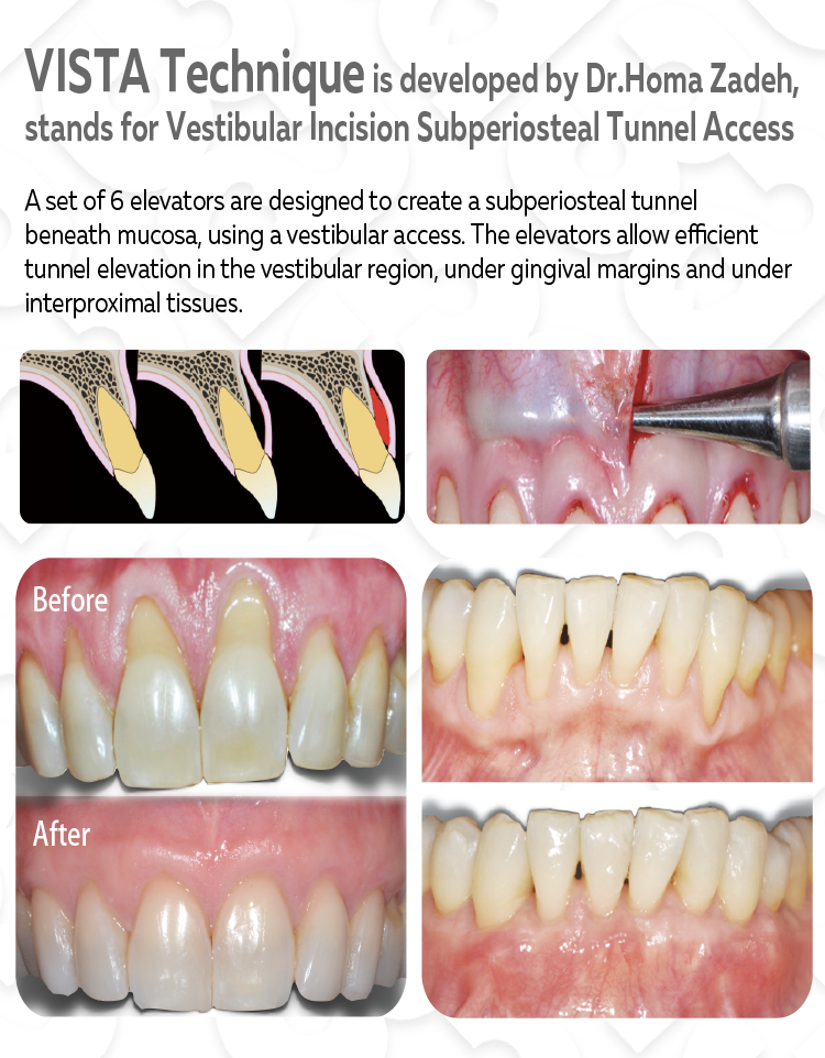 VISTA elevator set image 2