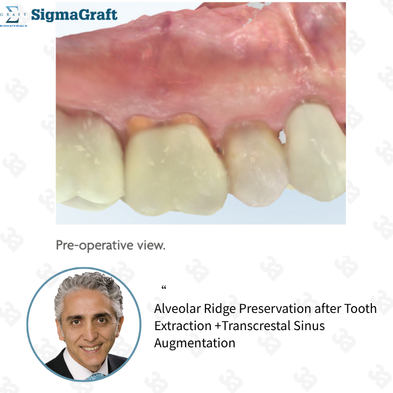 InterOss Collagen Plug Anorganic Bone-collagen Composite