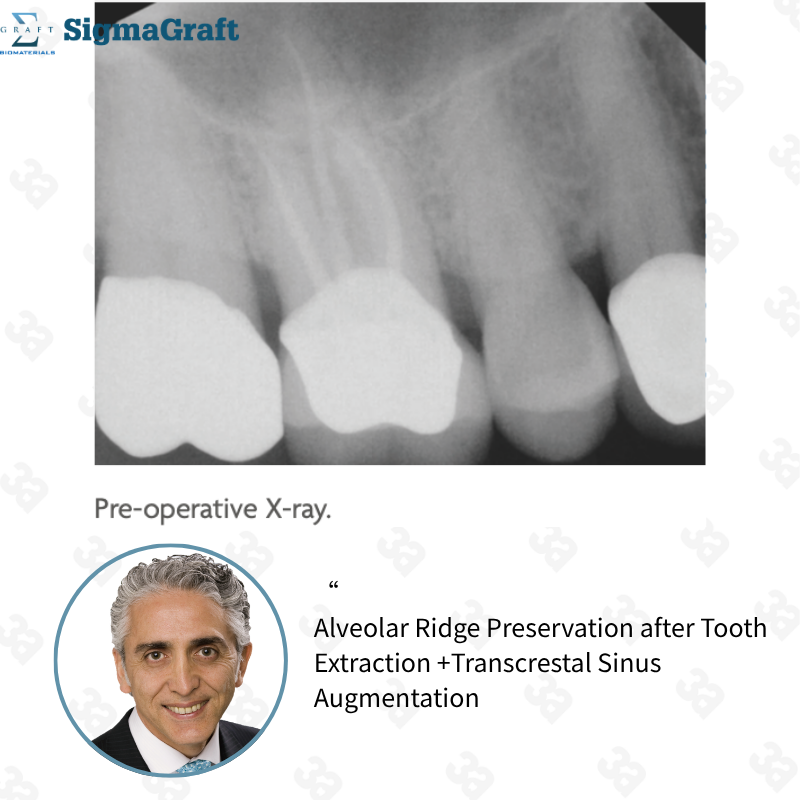 InterOss Collagen Plug Anorganic Bone-collagen Composite