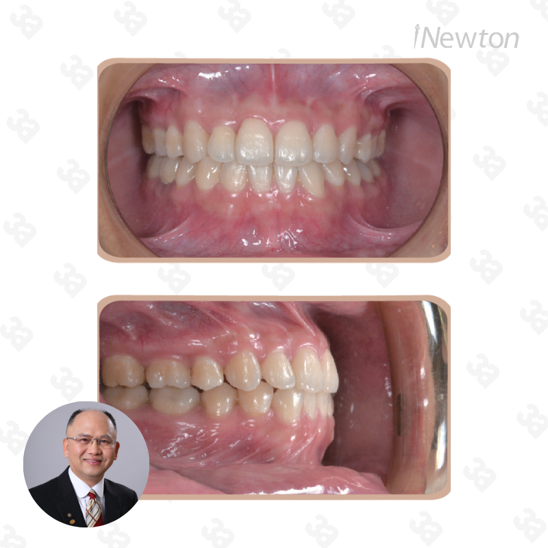 Double Retractor 2.0
