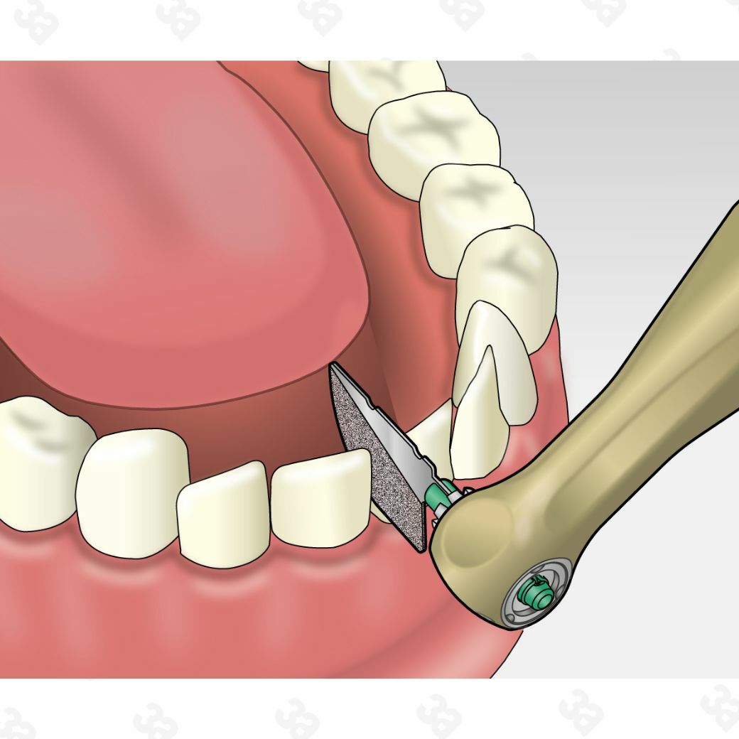 Profin PDX Handpiece