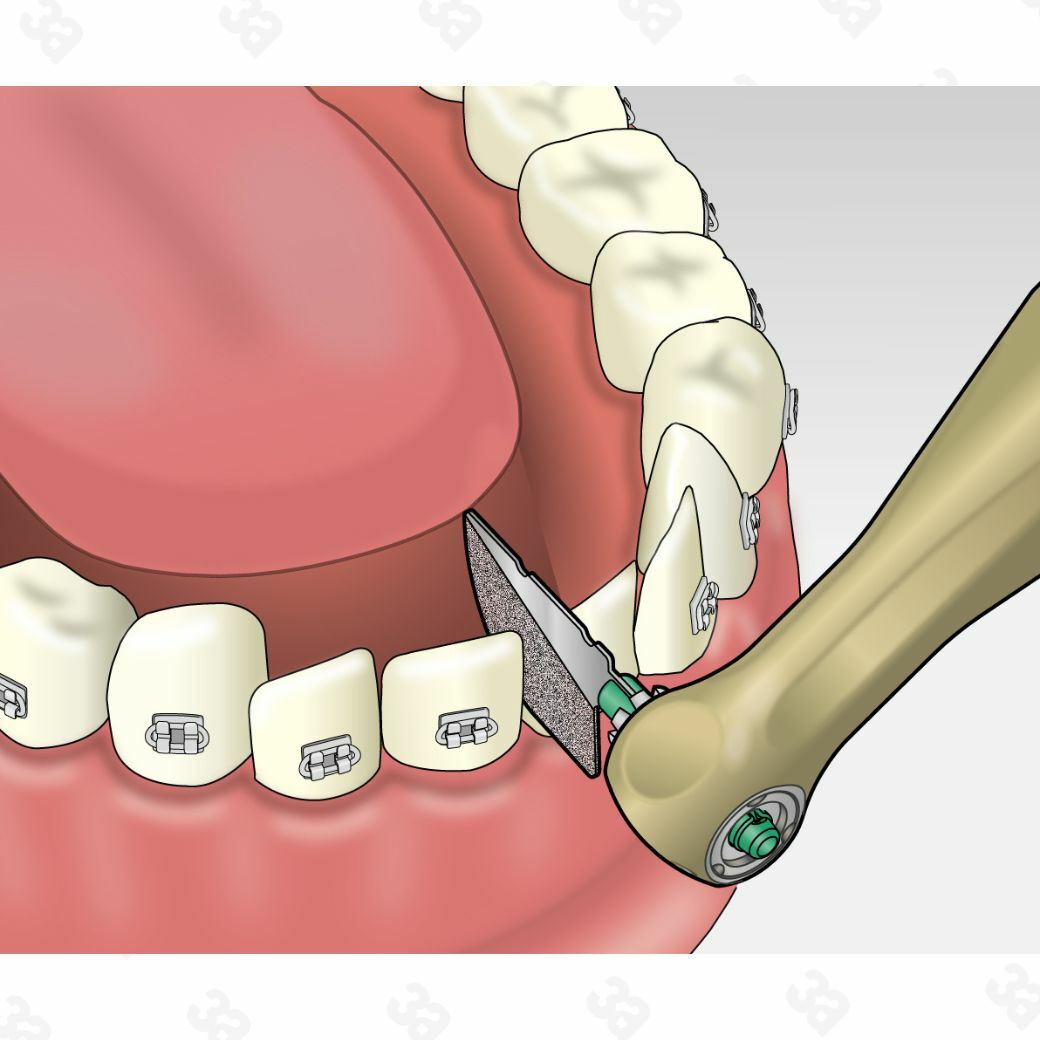Profin PDX Handpiece