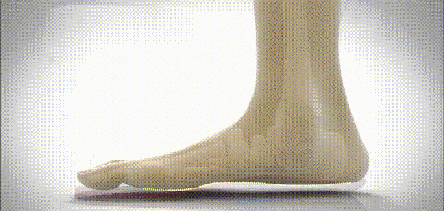 足裏アーチ 矯正