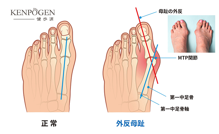 外反母趾とは