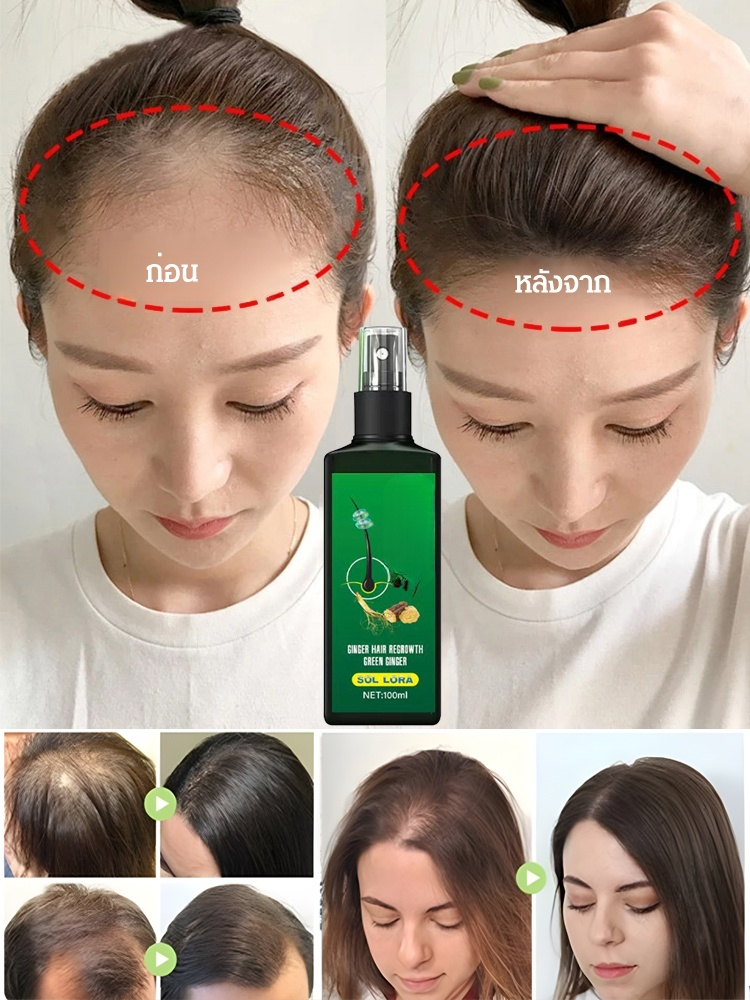 สเปรย์ปลูกผมบำรุงผม SOL LORA 