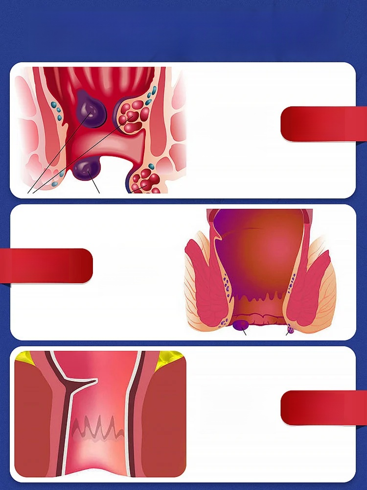 雲南本草黃連麝香肛泰噴霧