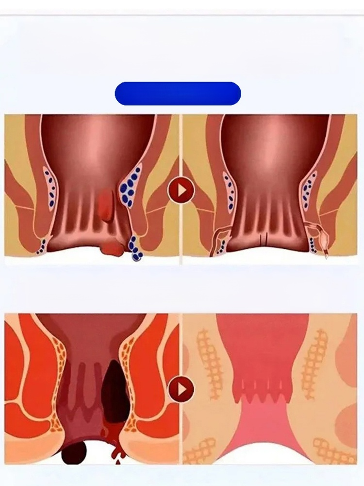 雲南本草黃連麝香肛泰噴霧