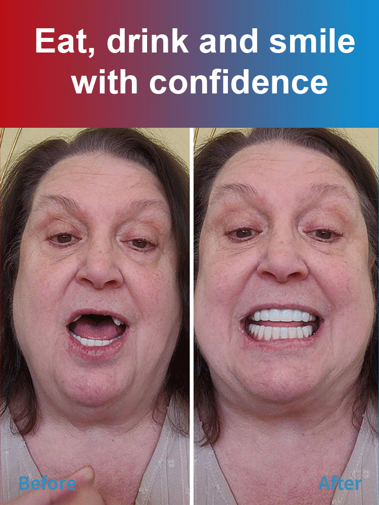 【🦷👨‍⚕️Recommended by renowned dental experts】Cosmetic dentures give you a confident smile and a comfortable, no-fuss look. Wear them the same day and chew hard foods the same day.