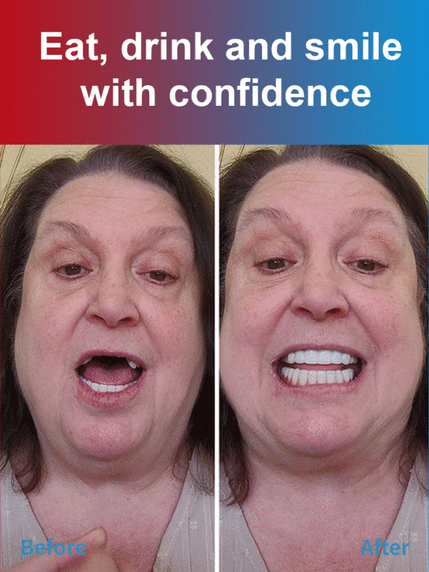 【🦷👨‍⚕️Recommended by renowned dental experts】Cosmetic dentures give you a confident smile and a comfortable, no-fuss look. Wear them the same day and chew hard foods the same day.