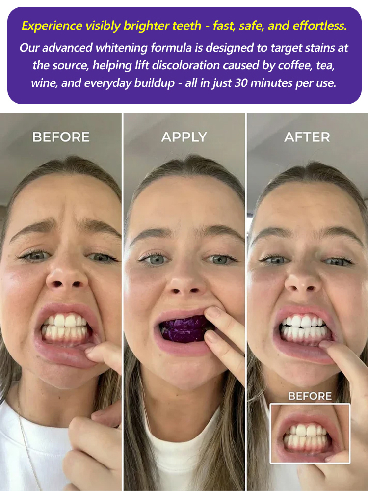 【At-Home Dental Whitening】Stop Hiding Your Smile – Get the 'Pearly White' Confidence You Deserve! 💎✨