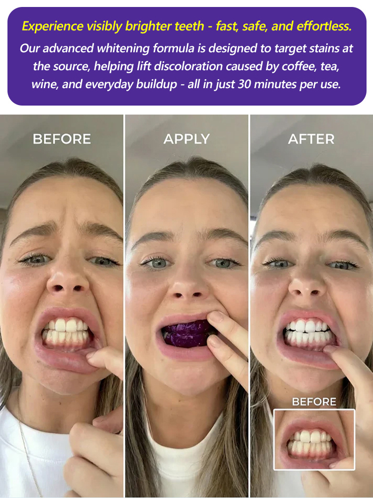【At-Home Dental Whitening】Stop Hiding Your Smile – Get the 'Pearly White' Confidence You Deserve! 💎✨