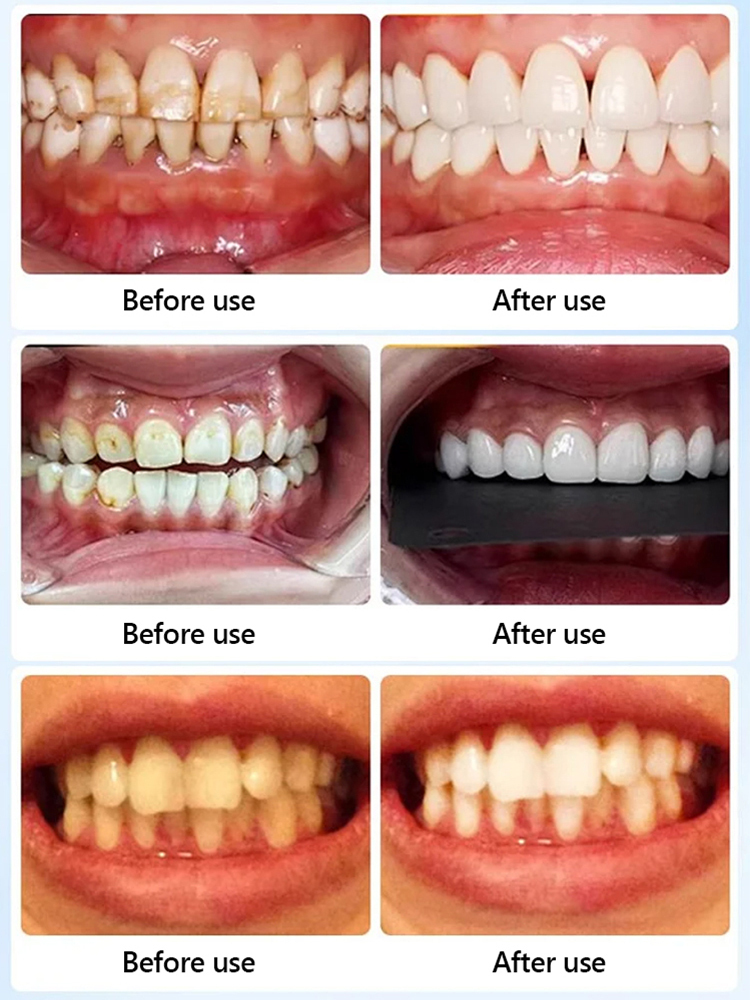 【At-Home Dental Whitening】Stop Hiding Your Smile – Get the 'Pearly White' Confidence You Deserve! 💎✨