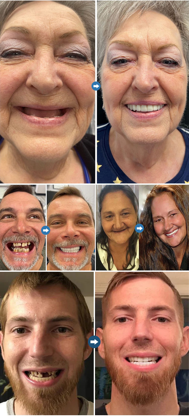 Medical-Grade Silicone Veneers - Comfortable Fit with Advanced Thermoplastic Technology