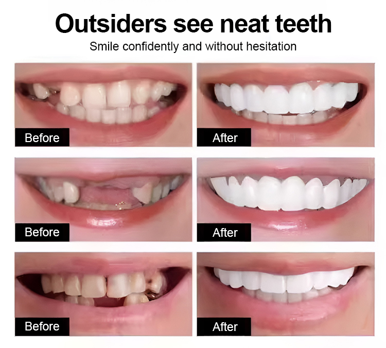 Perfect Smile Denture Set - Instant White, Natural-Looking Teeth