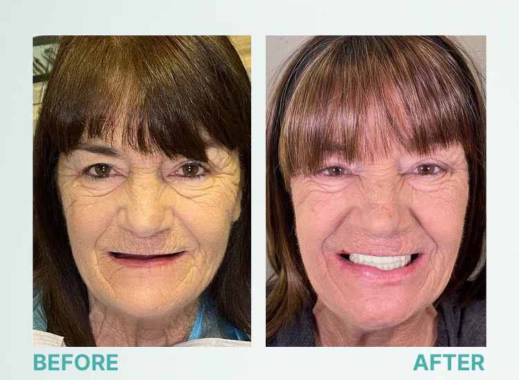 🎁🌎Ends Today: 70% OFF! Yagoo™ Medical Full Denture with Strong Suction^ 🏆 2026 Best Seller