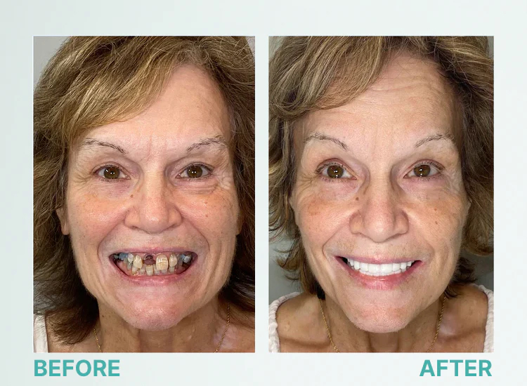 🎁🌎Ends Today: 70% OFF! Yagoo™ Medical Full Denture with Strong Suction^ 🏆 2026 Best Seller