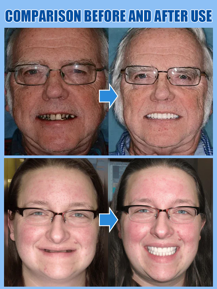[Over 300,000 users worldwide] Full-mouth bone-supported denture set