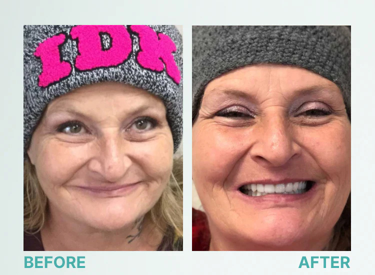 🎁🌎Ends Today: 70% OFF! Yagoo™ Medical Full Denture with Strong Suction^ 🏆 2026 Best Seller