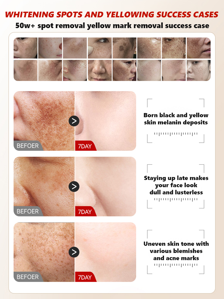 【3 in 1】Whitening, Anti-Blemish and Anti-Wrinkle Essence【See visible results in just 5 days!】
